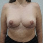 Breast Reduction Before & After Patient #2331