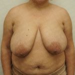 Breast Reduction Before & After Patient #2338