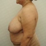 Breast Reduction Before & After Patient #2338