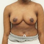 Breast Reduction Before & After Patient #2310