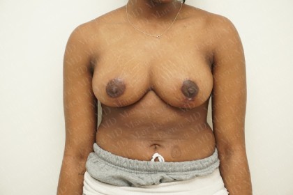 Breast Reduction Before & After Patient #2310