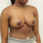 Breast Reduction Before & After Patient #2310