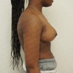 Breast Reduction Before & After Patient #2310