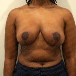 Breast Reduction Before & After Patient #2323