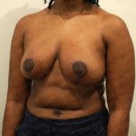 Breast Reduction Before & After Patient #2323