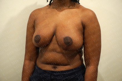 Breast Reduction Before & After Patient #2323