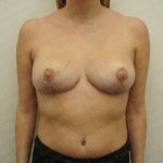 Breast Reduction Before & After Patient #2383