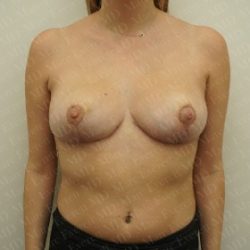 Breast Reduction Before & After Patient #2383
