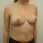 Breast Reduction Before & After Patient #2383