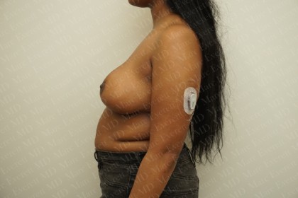 Breast Reduction Before & After Patient #2361