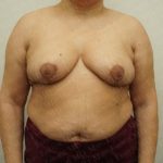 Breast Reduction Before & After Patient #2338