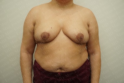 Breast Reduction Before & After Patient #2338