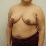 Breast Reduction Before & After Patient #2338