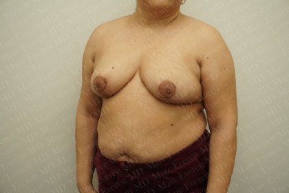 Breast Reduction Before & After Patient #2338