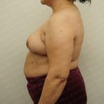 Breast Reduction Before & After Patient #2338