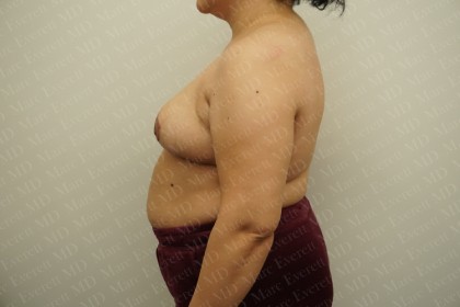Breast Reduction Before & After Patient #2338