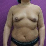 Breast Augmentation Before & After Patient #2452