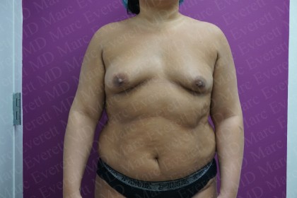 Breast Augmentation Before & After Patient #2452