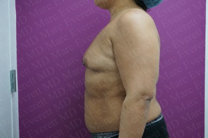 Breast Augmentation Before & After Patient #2452