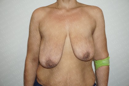 Breast Reduction Before & After Patient #2397