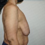 Breast Reduction Before & After Patient #2397
