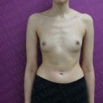 Breast Augmentation Before & After Patient #2460