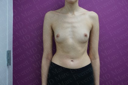 Breast Augmentation Before & After Patient #2460