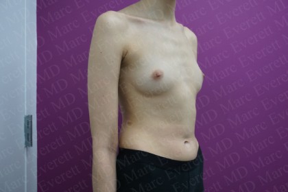Breast Augmentation Before & After Patient #2460