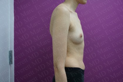 Breast Augmentation Before & After Patient #2460