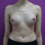 Breast Augmentation Before & After Patient #2460