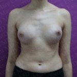 Breast Augmentation Before & After Patient #2460