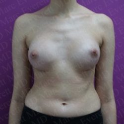 Breast Augmentation Before & After Patient #2460