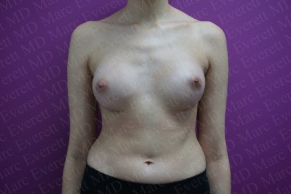 Breast Augmentation Before & After Patient #2460