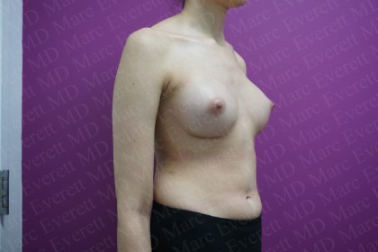 Breast Augmentation Before & After Patient #2460