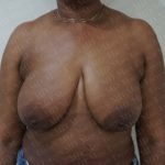 Breast Reduction Before & After Patient #2295
