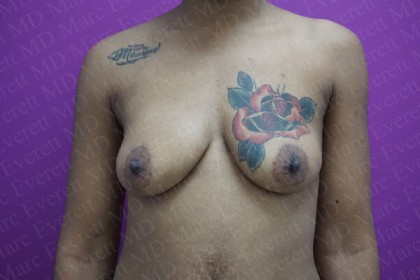 Breast Augmentation Before & After Patient #2516