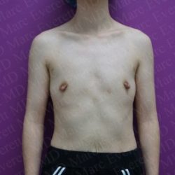 Breast Augmentation Before & After Patient #2481