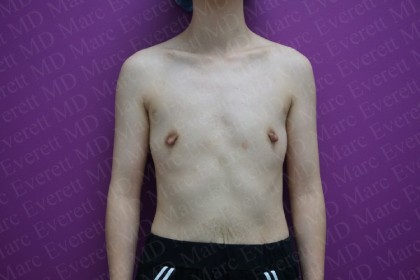 Breast Augmentation Before & After Patient #2481