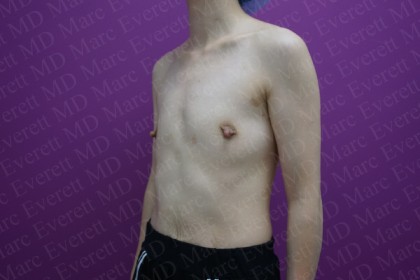 Breast Augmentation Before & After Patient #2481