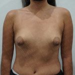 Tuberous Breast Surgery Before & After Patient #2412