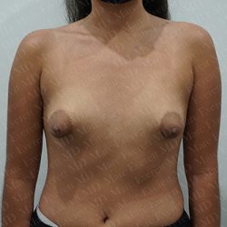 Tuberous Breast Surgery Before & After Patient #2412