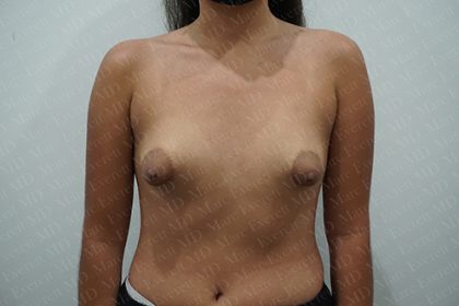 Tuberous Breast Surgery Before & After Patient #2412