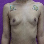 Breast Augmentation Before & After Patient #2445