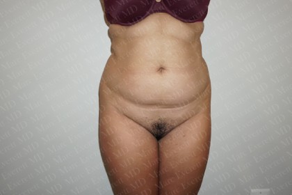 Liposuction Before & After Patient #2046