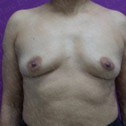 Breast Augmentation Before & After Patient #2523
