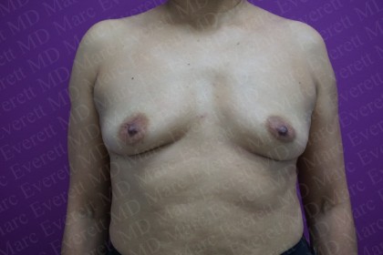 Breast Augmentation Before & After Patient #2523