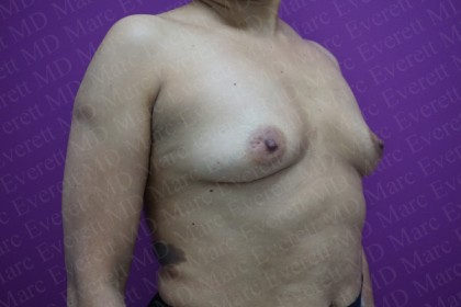 Breast Augmentation Before & After Patient #2523