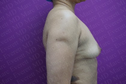 Breast Augmentation Before & After Patient #2523
