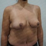 Breast Reduction Before & After Patient #2397