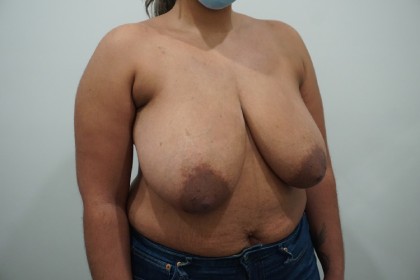 Breast Reduction Before & After Patient #2390